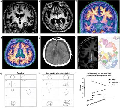 Case Report: Deep Brain Stimulation of the Nucleus Basalis of Meynert for Advanced Alzheimer's Disease